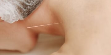Need To Know What Acupuncture Is All About?