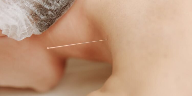 Need To Know What Acupuncture Is All About?